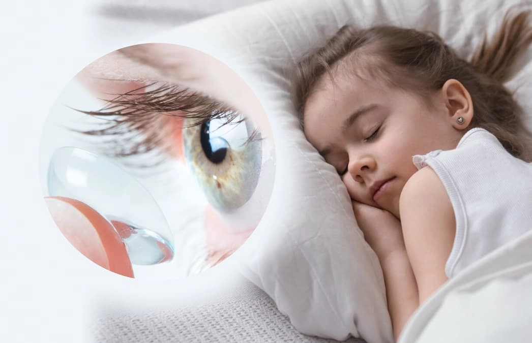 Ортокератология: Ночные линзы