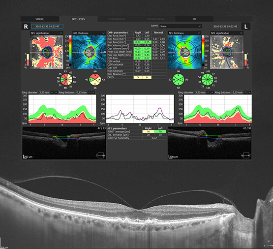 Tomografia in coerenta optica (OCT) – mai mult decat o simpla poza a retinei | schneiderturm.ro